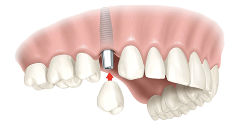 Single Dental Implants Williamsburg